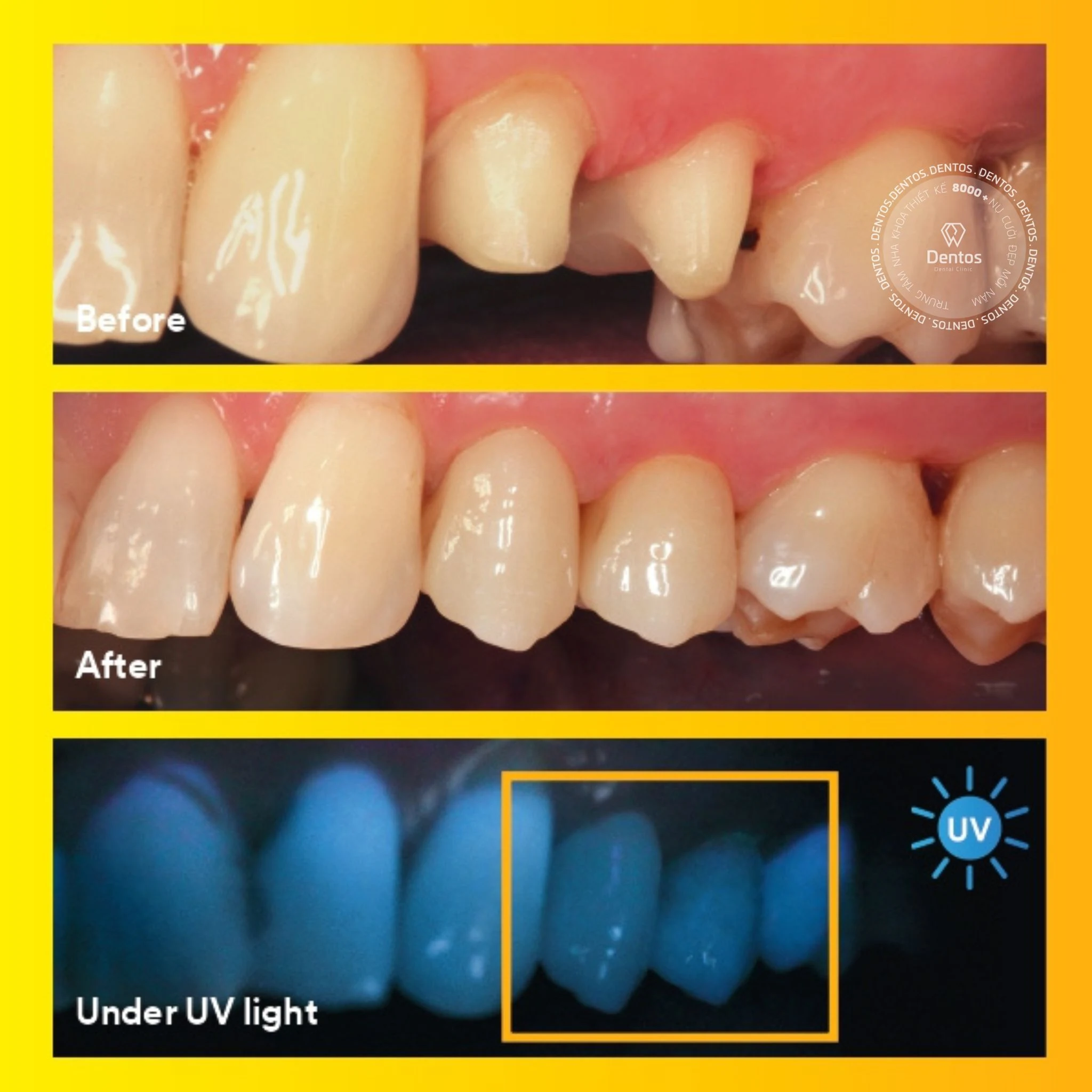 Lava là dòng răng sứ đầu tiên trên thế giới sở hữu đặc tính huỳnh quang ngay từ trong phôi sứ